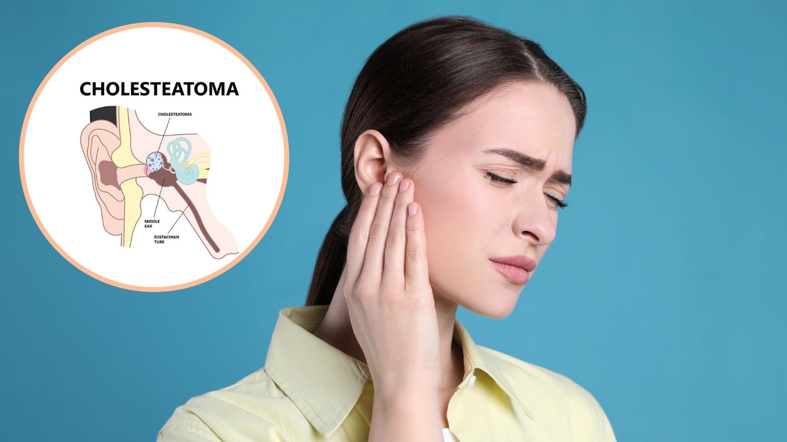 Cholesteatoma bẩm sinh là bệnh gì? Nguyên nhân, triệu chứng và cách điều trị