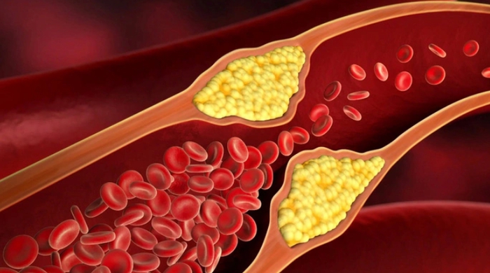 cholesterol-cao-dan-den-xo-vua-dong-mach-nguy-hiem-nhu-the-nao 2.jpg