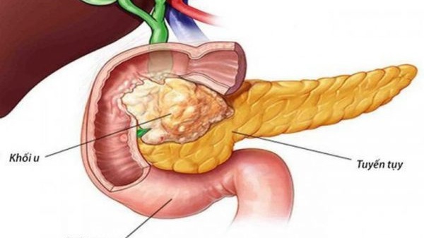 Tình trạng bệnh về tuyến tụy như tiểu đường và viêm tụy có ảnh hưởng như thế nào đến chức năng nội tiết của tuyến tụy?