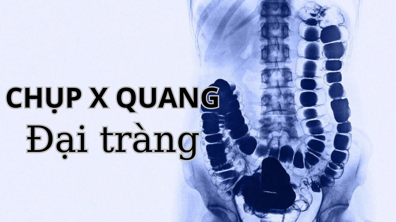 Chụp X quang đại tràng giúp chẩn đoán bệnh gì? Chi phí bao nhiêu?