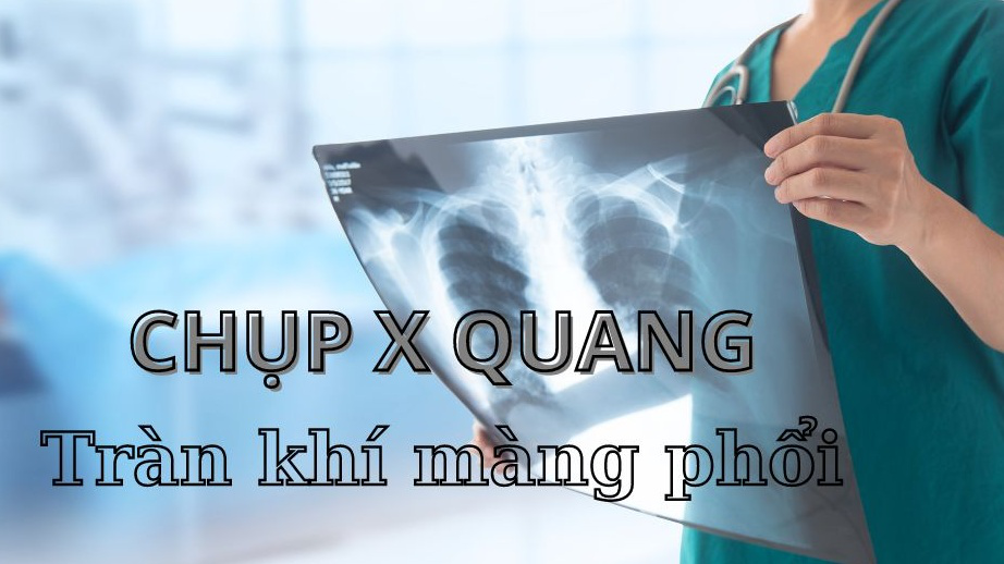 Chi tiết quy trình chụp X quang tràn khí màng phổi