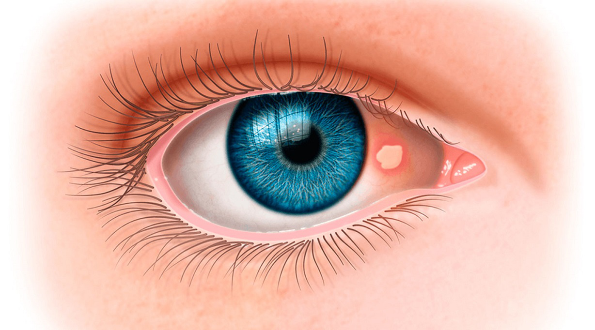 Cách nhận biết và chẩn đoán mộng mắt?
