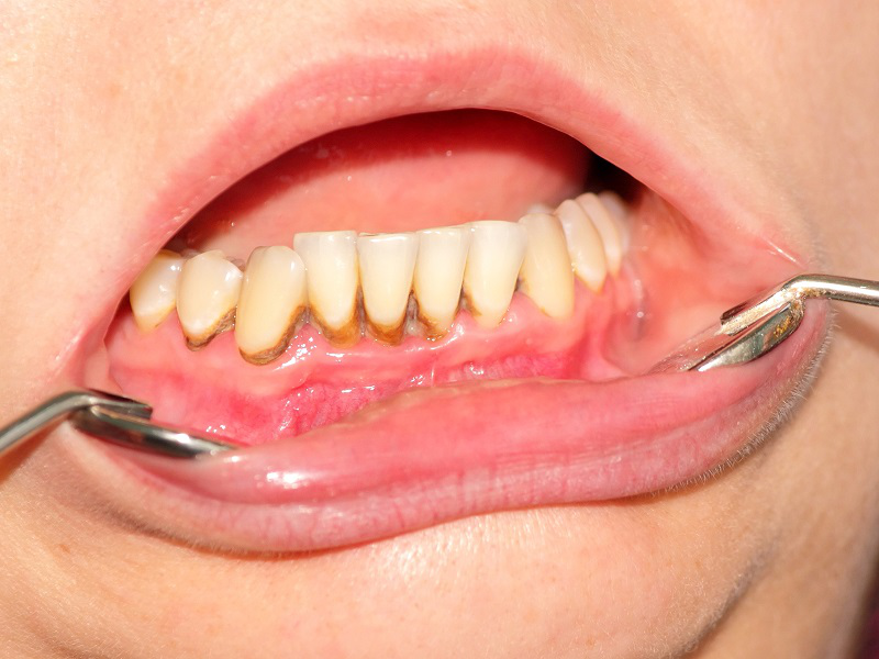 Có nên tẩy trắng răng không? Chi phí bao nhiêu? 5