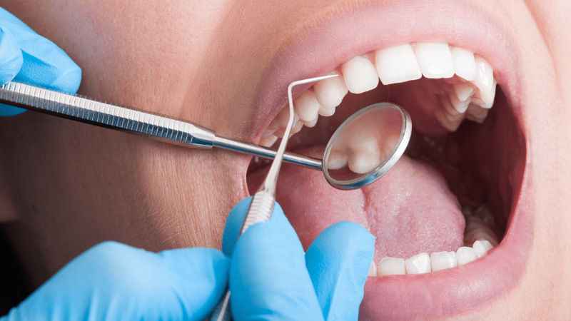 Có nên trồng implant răng cửa không và giá bao nhiêu? 4