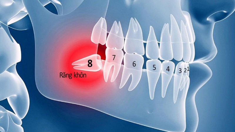 Có phải ai cũng mọc răng khôn hay không? 1