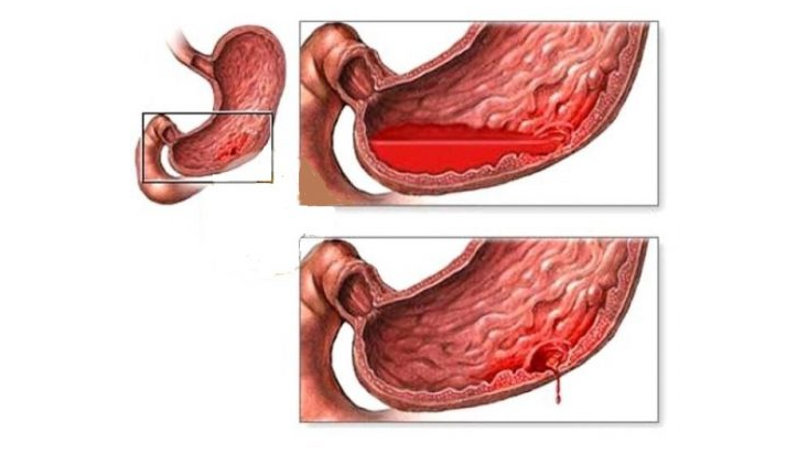 Coumarin: Hoạt chất chống lại các bệnh lý do huyết khối gây nên 6.png