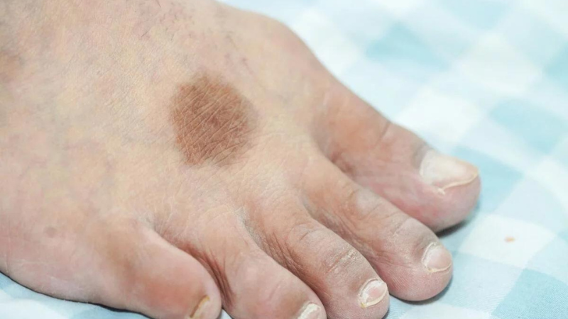 Da chân bị đốm nâu: Nguyên nhân, cách can thiệp và phòng ngừa 3