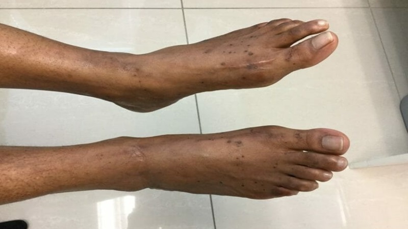 Da chân bị đốm nâu: Nguyên nhân, cách can thiệp và phòng ngừa 4