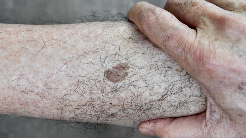 Da chân bị đốm nâu: Nguyên nhân, cách can thiệp và phòng ngừa 5