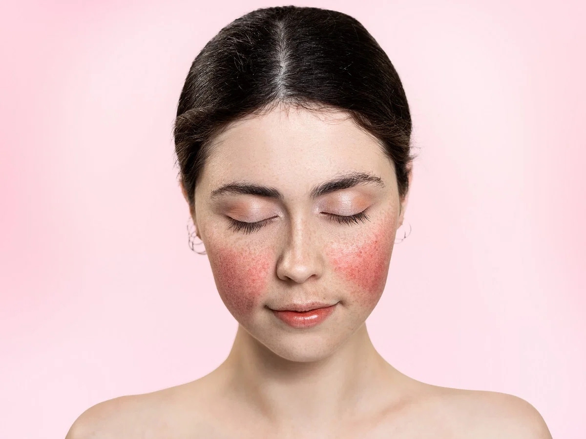 Da mặt bị đỏ - Dấu hiệu của hội chứng Rosacea