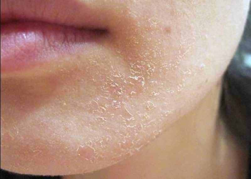 Da mặt sần sùi: Nguyên nhân, dấu hiệu và cách chữa trị