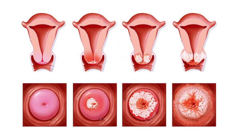 Đặc điểm từng giai đoạn của ung thư cổ tử cung 2
