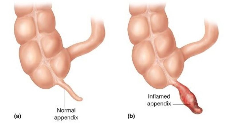 Đám quánh ruột thừa và những điều cần biết