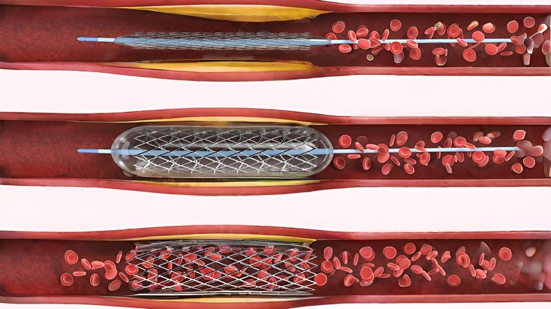 Đặt stent phủ thuốc có an toàn không?