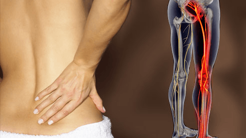 Bên cạnh đau cơ, còn có những triệu chứng khác đi kèm khi bị đau mông không?
