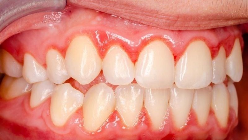 Đau chân răng và những điều cần biết 3