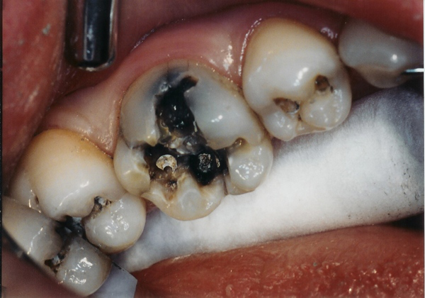 Đau chân răng và những điều cần biết 4