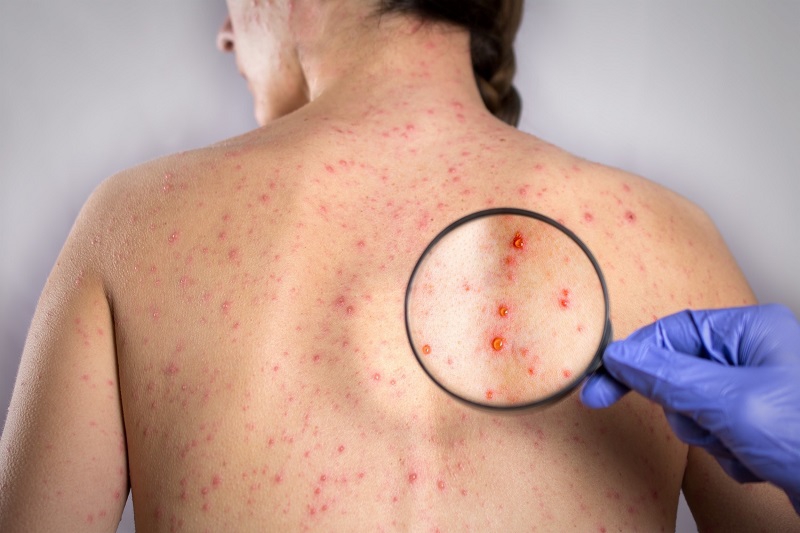 dau-hieu-cum-rubella-ba-bau-la-gi-nhung-bien-chung-co-the-xay-ra 1.jpg