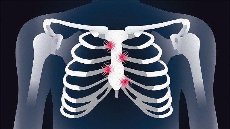 Dấu hiệu đau nhói ở ngực cảnh báo bệnh lý nào? 3