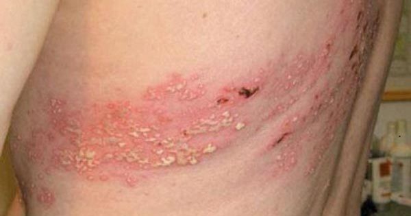 Triệu chứng của bệnh giời leo có thể xuất hiện ở những vùng da nào?

