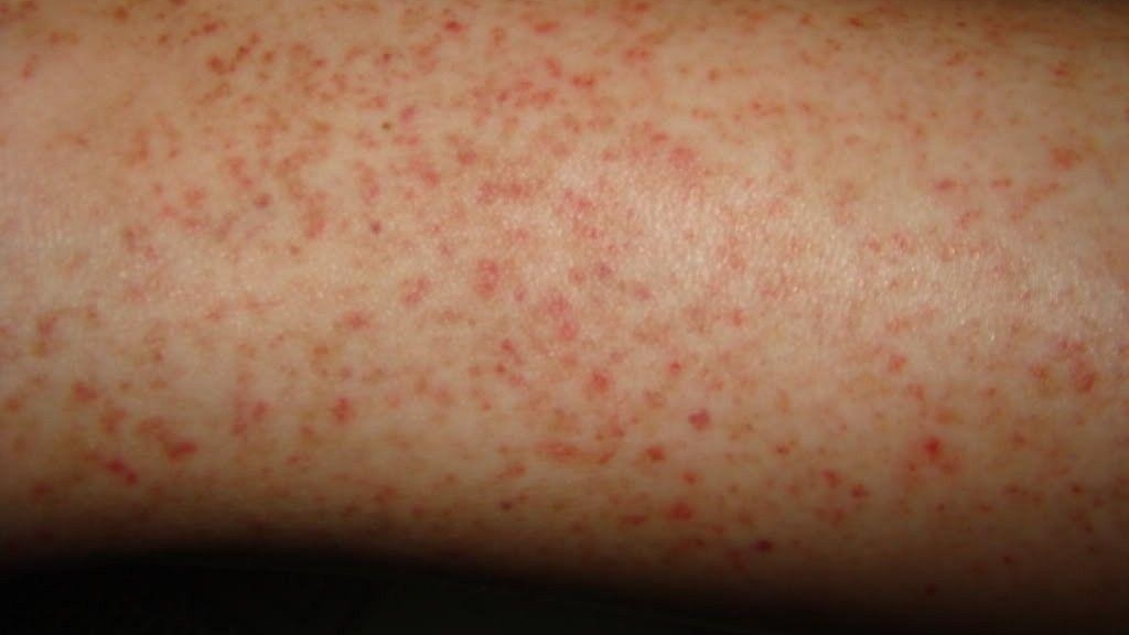 Bệnh viêm nang lông hồng ban hình mạng lưới có phổ biến không?
