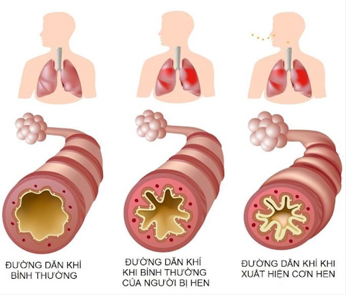 Dấu hiệu nhận biết khi lên cơn hen và cách cấp cứu hen suyễn