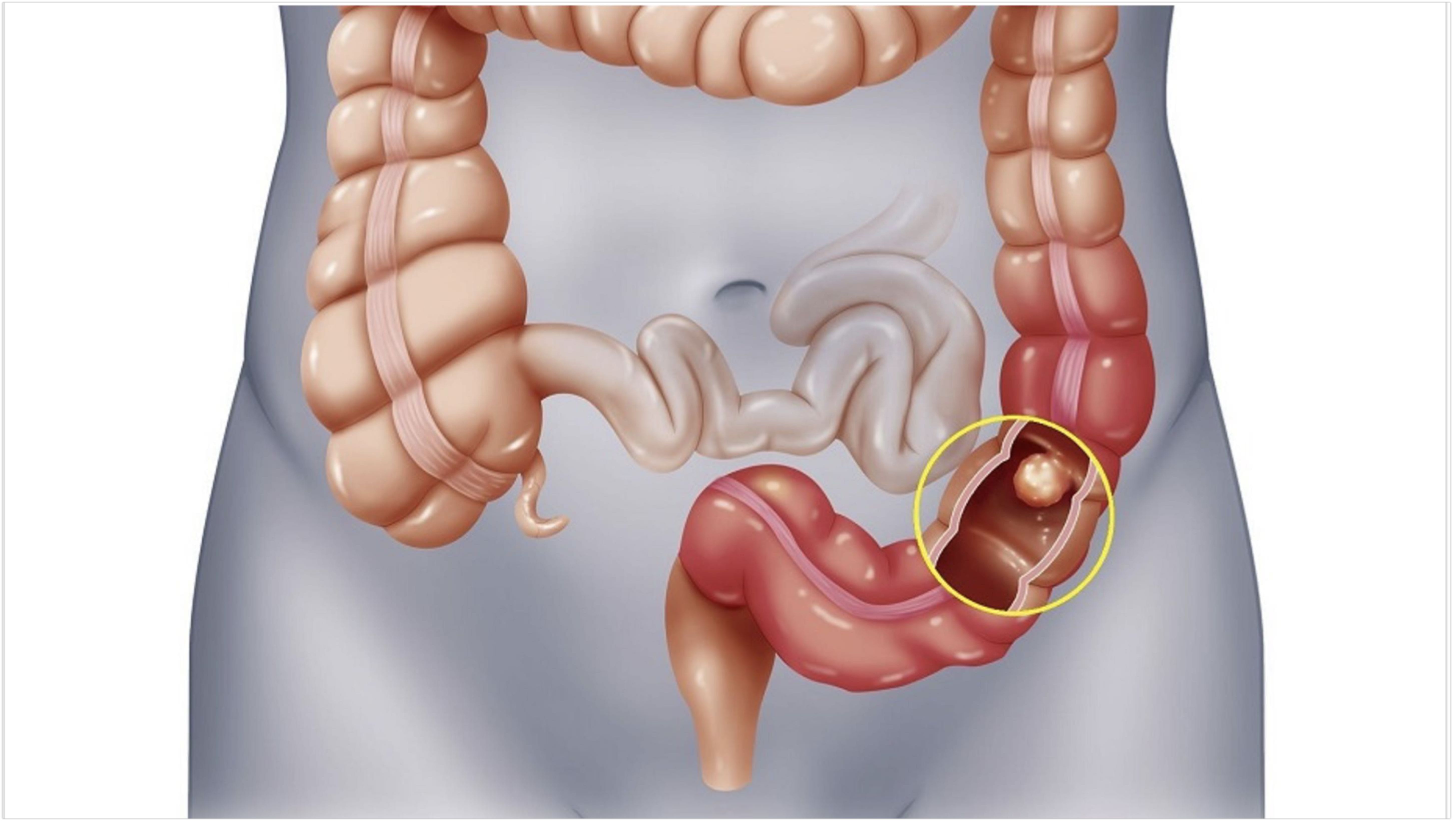 Những dấu hiệu nhận biết ung thư đại tràng