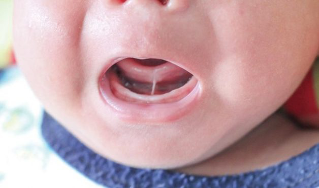 Dấu hiệu phân biệt lưỡi bình thường và dính thắng lưỡi