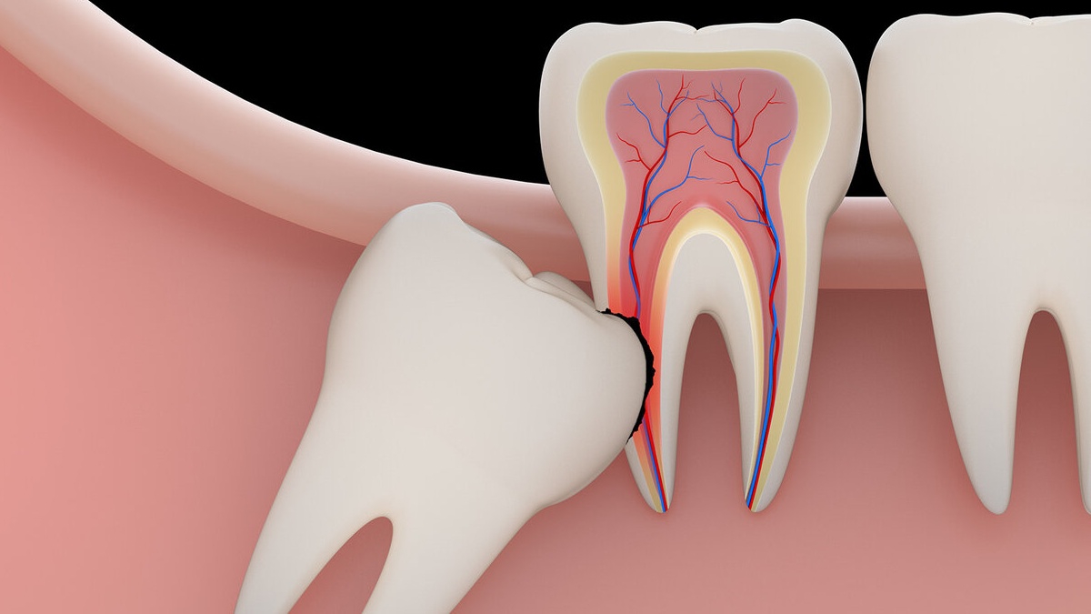 6 dấu hiệu răng khôn mọc lệch và các kiểu răng khôn mọc lệch phổ biến