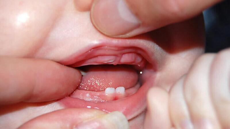 Dấu hiệu trẻ mọc răng hàm và cách chăm sóc 1