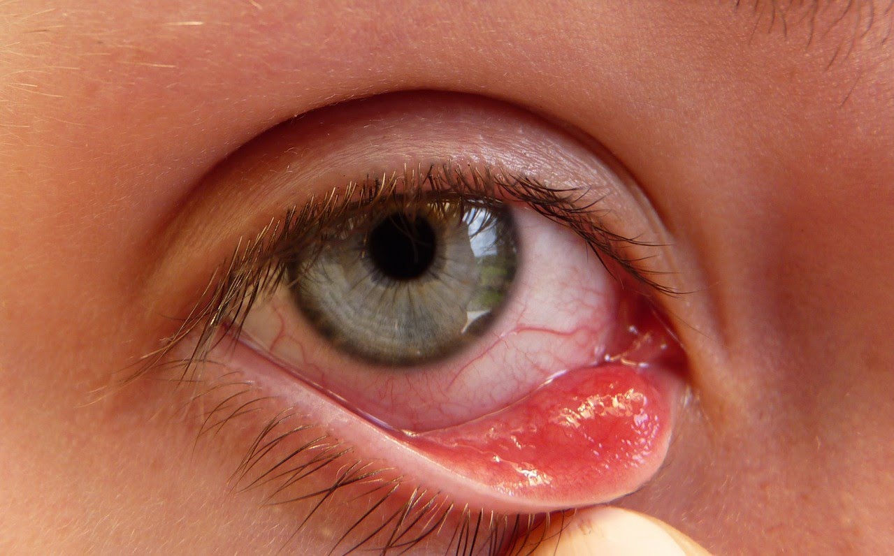 Có những biện pháp từ thiên nhiên nào giúp làm giảm mắt sưng đỏ có ghèn?