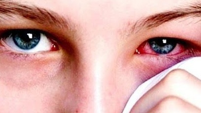 Đau mắt đỏ không nên ăn gì? Những thực phẩm cần lưu ý khi đau mắt đỏ