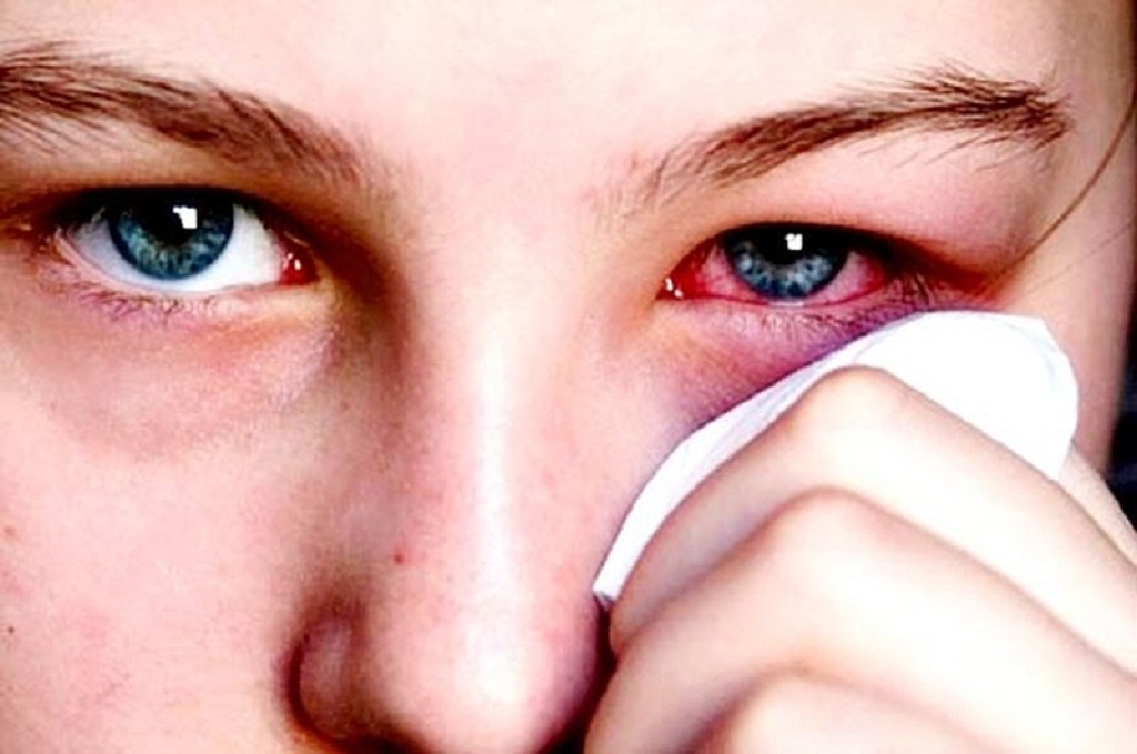 Có cần dùng thuốc kháng sinh khi bị đau mắt đỏ nhẹ không?
