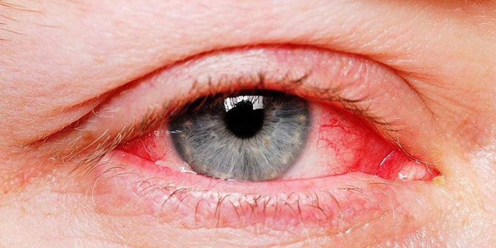 Đau mắt hàn là gì và nguyên nhân gây ra?
