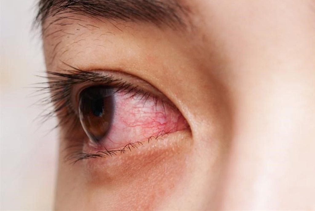 Làm thế nào để sử dụng đúng nha đam để giảm đau mắt do hàn?
