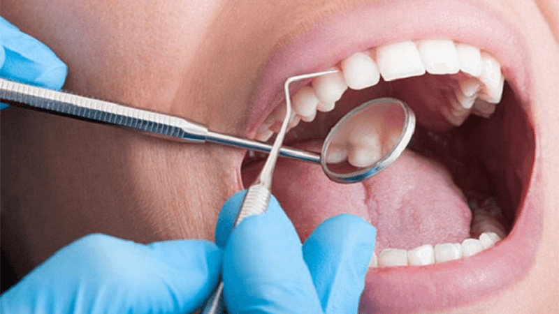 Nguyên nhân gây đau nhức răng cửa và cách khắc phục 3