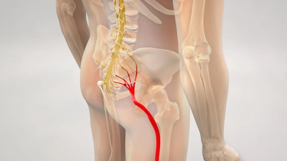 Ôn tập về bệnh thoái hóa cột sống và mối liên hệ với đau nhức từ mông xuống bắp chân phải.