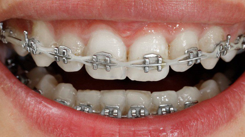 Thuốc lá có liên quan đến tình trạng dây thun niềng răng bị vàng không?

