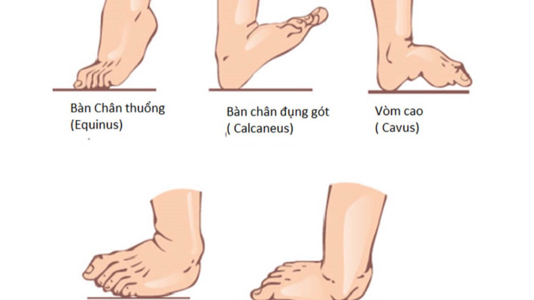 Những điều cần biết về dị tật bàn chân vẹo ở trẻ em