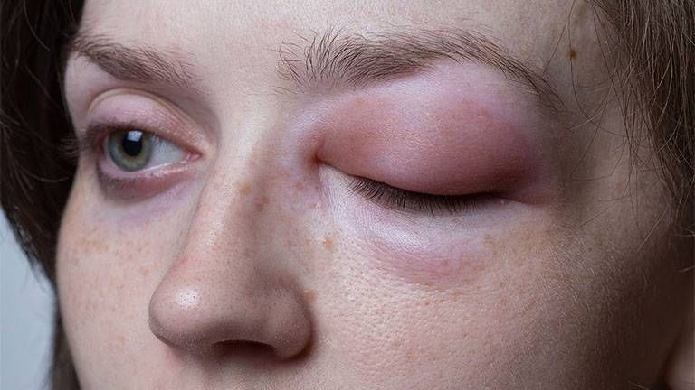 Cách giúp giảm sưng tấy ở mắt khi bị dị ứng thuốc?
