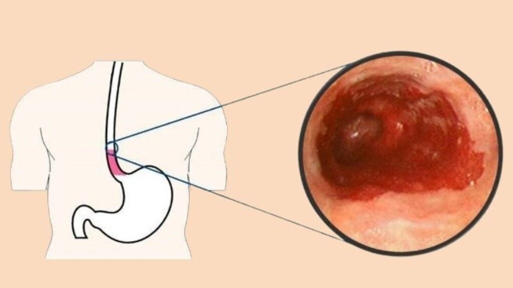 Điều trị bệnh loét thực quản như thế nào?