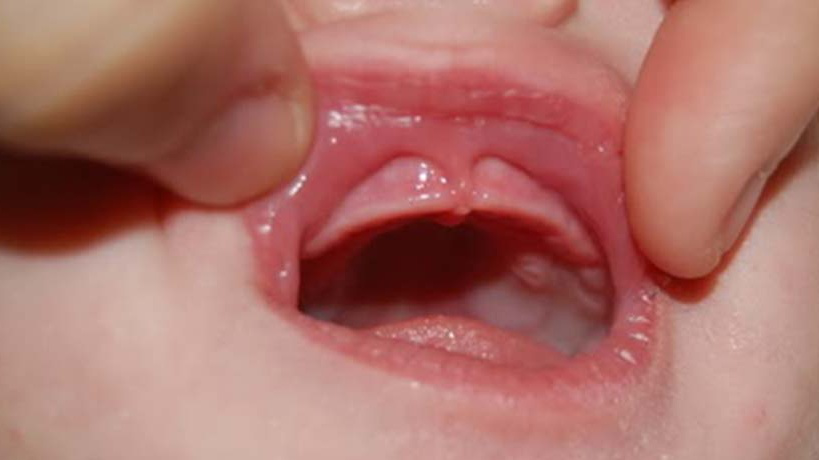 Dính thắng môi trên ở trẻ sơ sinh là gì và những điều cần biết ...