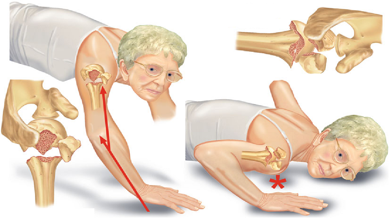 Gãy đầu trên xương cánh tay: Nguyên nhân, dấu hiệu và giải pháp 5