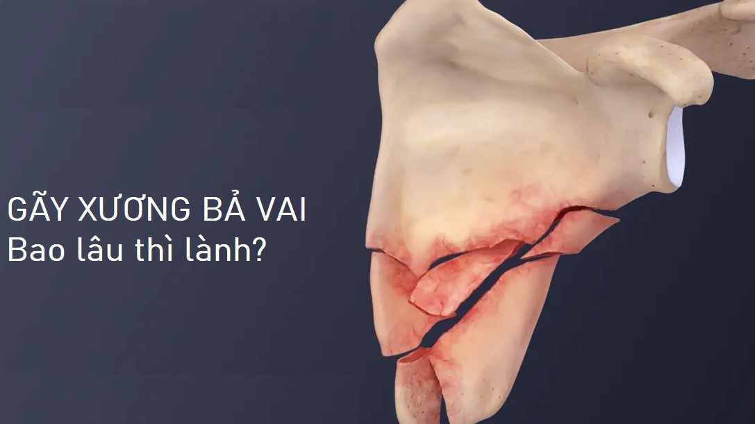 Gãy xương bả vai bao lâu thì lành?