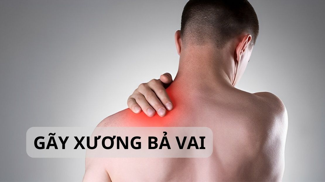 Gãy xương bả vai: Nguyên nhân và cách điều trị