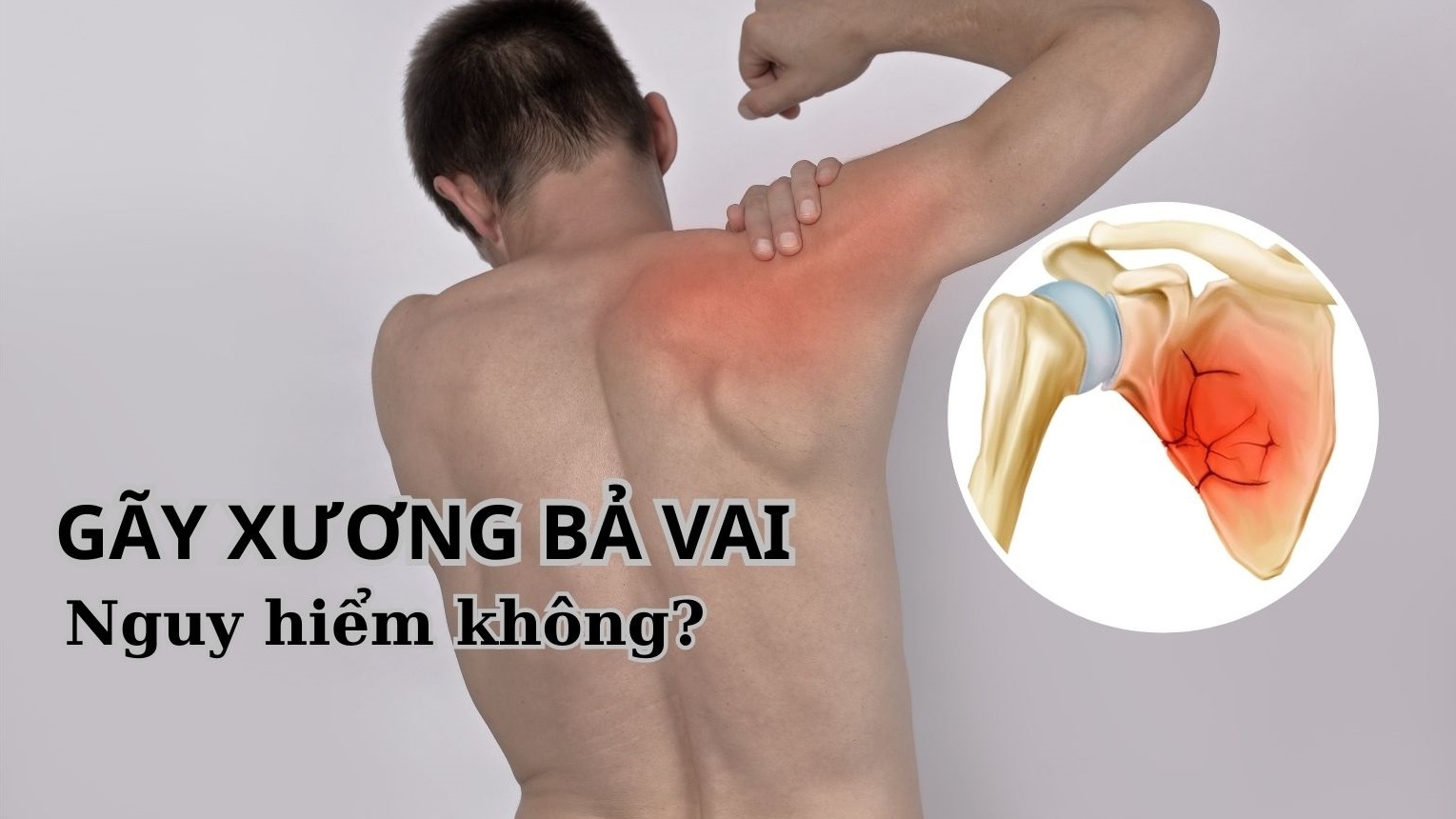 Gãy xương bả vai có nguy hiểm không?