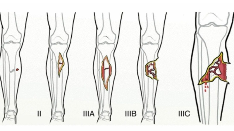 Gãy xương hở: Nguyên nhân, biến chứng và cách điều trị