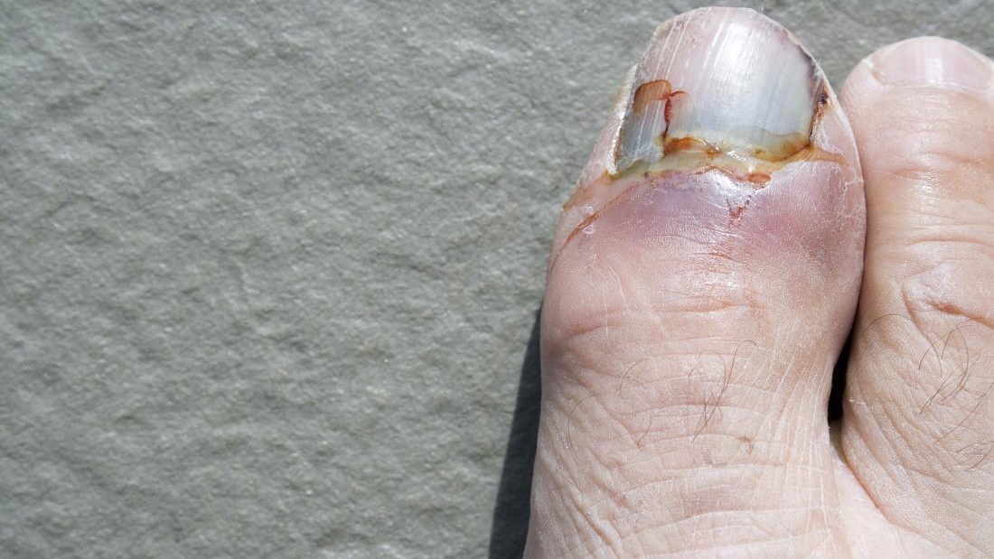 Khả năng chữa trị hoàn toàn của gãy ngón chân cái?