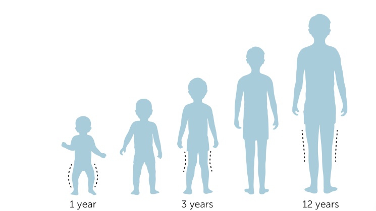 Dáng chân bình thường theo tuổi phát triển của trẻ 2