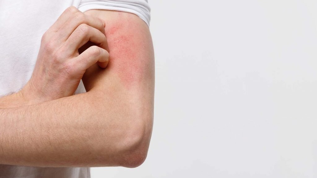 Phương pháp điều trị hiệu quả và ngăn ngừa bệnh ghẻ ruồi?
